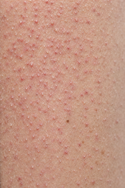 Close-up of red dots and rough bumps from keratosis pilaris on the upper arm