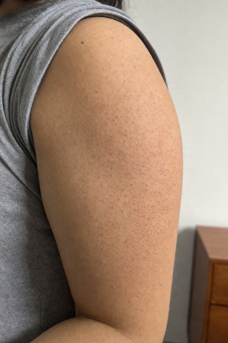 Illustration of the back of an upper arm with rough keratosis pilaris bumps