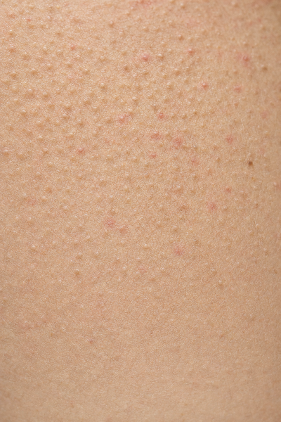 Close-up of rough, bumpy chicken skin with light redness