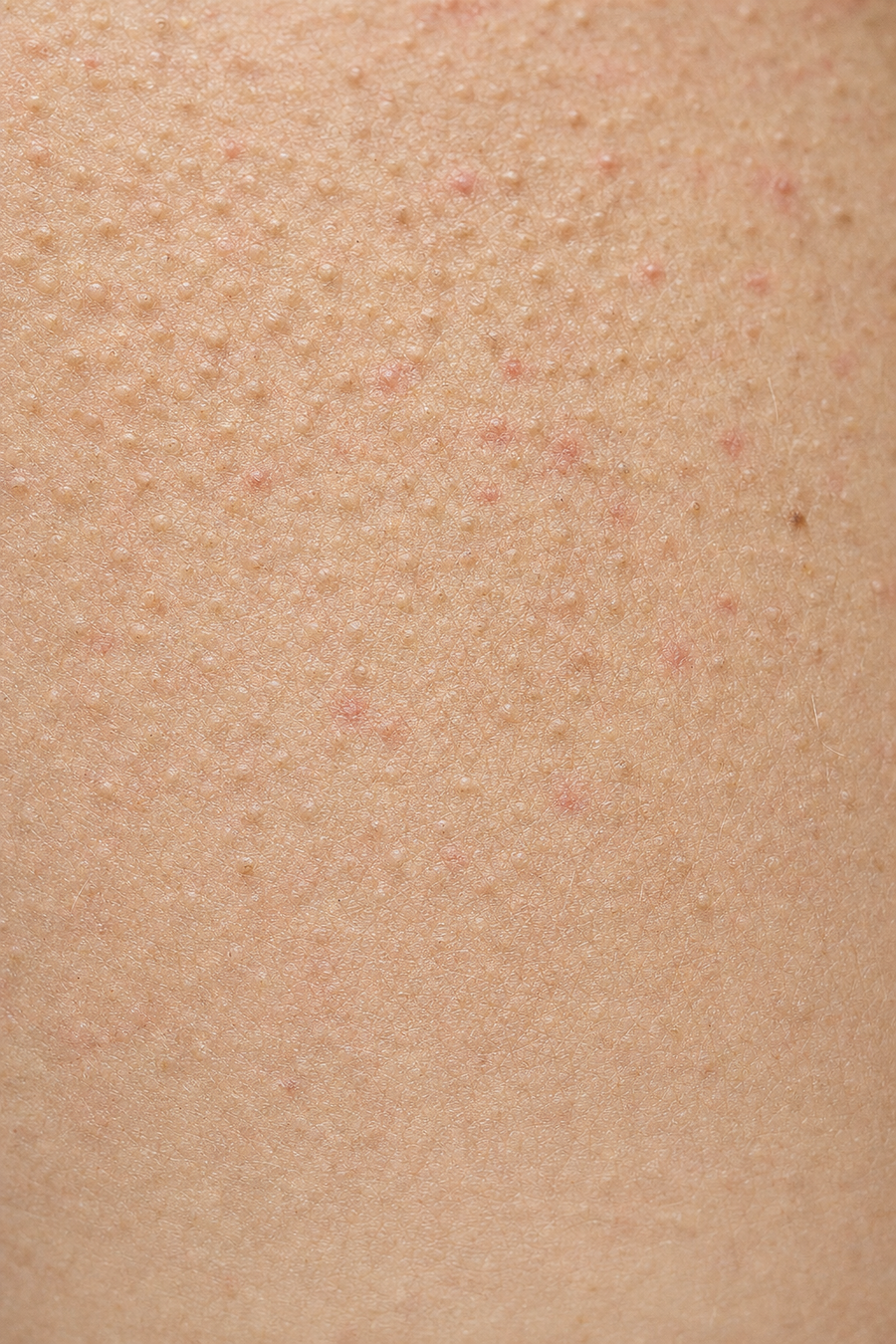 Close-up of rough, bumpy skin from keratosis pilaris