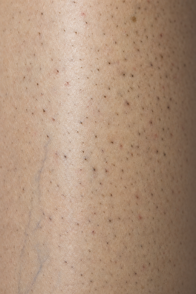 Strawberry legs: dark dotted pores on a shaved leg