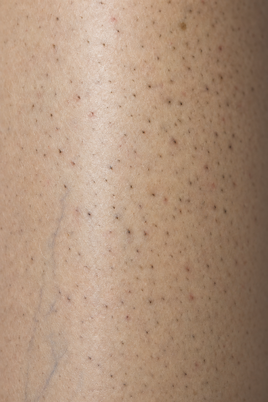 Close-up of a leg with small dark dots, often called strawberry legs
